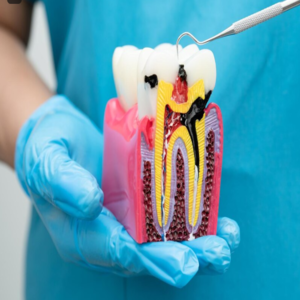 root canal treatment in kphb