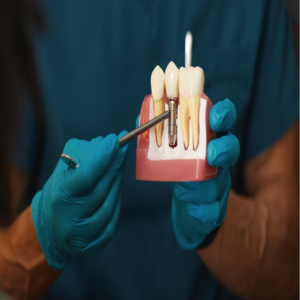 Dental implants dental Clinic in KPHB