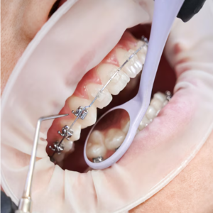 Best Dental Braces Treatment In kphb